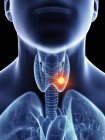 Illustration of throat cancer in male body silhouette, close-up. — Stock Photo