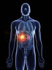 Darstellung von Nierenkrebs in männlicher Körpersilhouette auf schwarzem Hintergrund. — Stockfoto