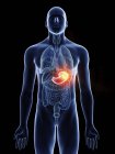 Ілюстрація раку шлунка в чоловічому організмі силует на чорному фоні. — стокове фото