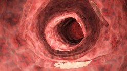 Illustrazione digitale del colon umano infiammato . — Foto stock