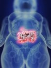Ilustración de la silueta humana con el intestino inflamado . - foto de stock