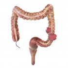 3d rendered illustration of colon cancer on white background. — Stock Photo