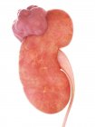 3d renderizado ilustración de cáncer de riñón sobre fondo blanco . - foto de stock