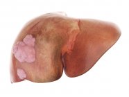 Illustrazione resa 3d del cancro al fegato su sfondo bianco . — Foto stock