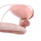3D gerenderte Darstellung von Prostatakrebs auf weißem Hintergrund. — Stockfoto