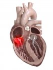 3D gerenderte Darstellung der erkrankten Herzklappe auf weißem Hintergrund. — Stockfoto
