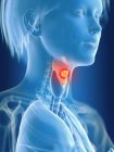 3d renderizado ilustración de color cáncer de laringe femenina en la silueta del cuerpo . - foto de stock