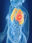 3D ілюстрація кольорового жіночого раку легень в силуеті тіла . — стокове фото