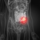 Ilustración del cáncer de intestino delgado en la silueta del cuerpo humano
. - foto de stock