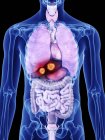 Ilustración del cáncer de hígado en la silueta del cuerpo humano . - foto de stock