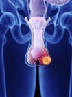 Illustration du cancer des testicules dans la silhouette du corps humain . — Photo de stock