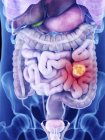 Illustration du cancer de l'intestin dans la silhouette du corps humain . — Photo de stock