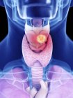 Illustration du cancer du larynx dans la silhouette du corps humain . — Photo de stock