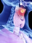 Ilustración del cáncer de laringe en la silueta del cuerpo humano . - foto de stock