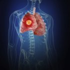 Darstellung von Lungenkrebs in der Silhouette des menschlichen Körpers. — Stockfoto