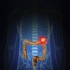 Ilustração do câncer de cólon na silhueta do corpo humano . — Fotografia de Stock
