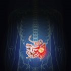 Ilustración del cáncer de intestino en la silueta del cuerpo humano . - foto de stock