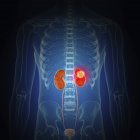 Ilustração do câncer renal na silhueta do corpo humano . — Fotografia de Stock