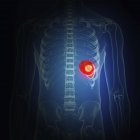 Illustration of spleen cancer in human body silhouette. — Stock Photo