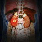 Ilustración del cáncer renal en la silueta del cuerpo humano . - foto de stock
