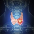 Ilustração do câncer de tireoide na silhueta da garganta humana . — Fotografia de Stock