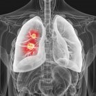 Darstellung von Lungenkrebs in der Silhouette des menschlichen Körpers. — Stockfoto