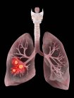 Illustration menschlicher Lungen und Bronchialkrebs. — Stockfoto