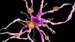 Farbige Darstellung von Amyloid-Plaques auf Nervenzellen. — Stockfoto