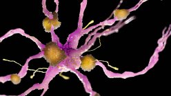 Кольорові ілюстрації амілоїду бляшок на нервові клітини. — стокове фото