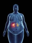 Illustrazione della silhouette dell'uomo obeso con tumore renale evidenziato . — Foto stock