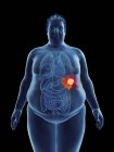 Illustrazione della silhouette dell'uomo obeso con tumore della milza evidenziato . — Foto stock