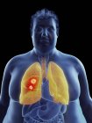 Illustration der Silhouette eines fettleibigen Mannes mit hervorgehobenem Lungentumor. — Stockfoto