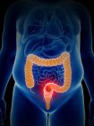 Illustrazione del cancro del colon nella silhouette del corpo umano . — Foto stock
