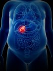 Ilustración del cáncer de vesícula biliar en la silueta del cuerpo humano . - foto de stock