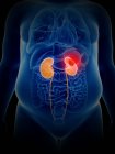 Illustrazione del cancro ai reni nella silhouette del corpo umano . — Foto stock
