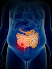 Illustrazione del cancro intestinale nella silhouette del corpo umano . — Foto stock