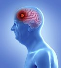 Illustration de tumeur au cerveau dans la silhouette d'un homme âgé . — Photo de stock