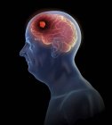 Illustrazione del tumore al cervello nella silhouette dell'uomo anziano . — Foto stock