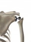 Ilustração da substituição do ombro no esqueleto humano . — Fotografia de Stock
