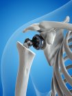 Illustrazione della sostituzione della spalla nello scheletro umano . — Foto stock