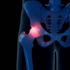 Illustrazione digitale dell'articolazione dolorosa dell'anca nello scheletro umano . — Foto stock