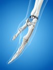 Illustration of wrist replacement on blue background. — Stock Photo