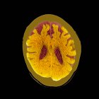 Tomografía computarizada coloreada de sección a través del cerebro de un paciente varón mayor con demencia . - foto de stock
