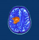 Tomografía computarizada de color azul de la sección cerebral de una paciente mayor con cáncer de cerebro de glioblastoma . - foto de stock