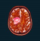 Червоне кольорове комп'ютерне томографічне сканування ділянки мозку старшої жінки пацієнта з гліобластомою раком мозку . — стокове фото
