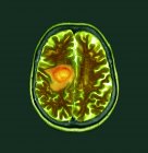 Зелене кольорове комп'ютерне томографічне сканування ділянки мозку старшої жінки пацієнта з гліобластомою раком мозку . — стокове фото