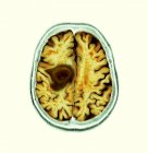 Жовті кольорові комп'ютерні томографічні сканування ділянки мозку старшої жінки пацієнта з гліобластомою мозку раком . — стокове фото