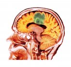 Tomografia computadorizada colorida de seção cerebral de paciente sênior do sexo feminino com câncer de cérebro glioblastoma . — Fotografia de Stock
