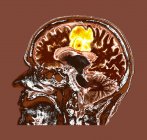 Цветная компьютерная томография участка мозга пожилой пациентки с глиобластомой
. — стоковое фото