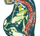 Radiografia colorida de secção através da coluna torácica de paciente do sexo masculino com espondilite anquilosante com grave degeneração da coluna torácica inferior . — Fotografia de Stock